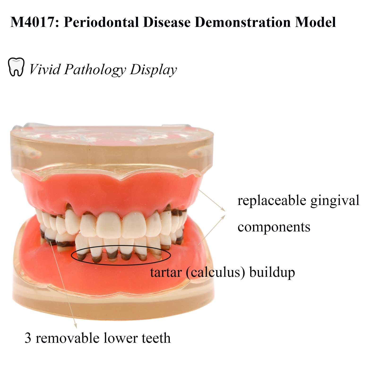 Periodontal Disease Demo Study Teach Pathology Display tartar Model M4017