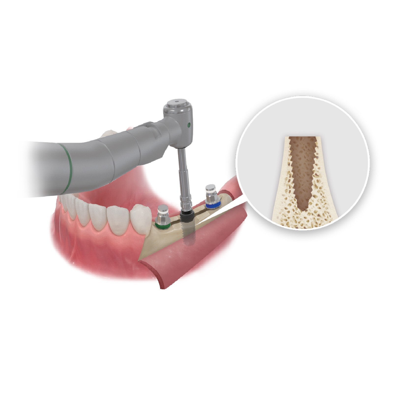 HIOSSEN OSSTEM Style Implant ESSET Kit Easy Split Expansion of the Narrow Ridge