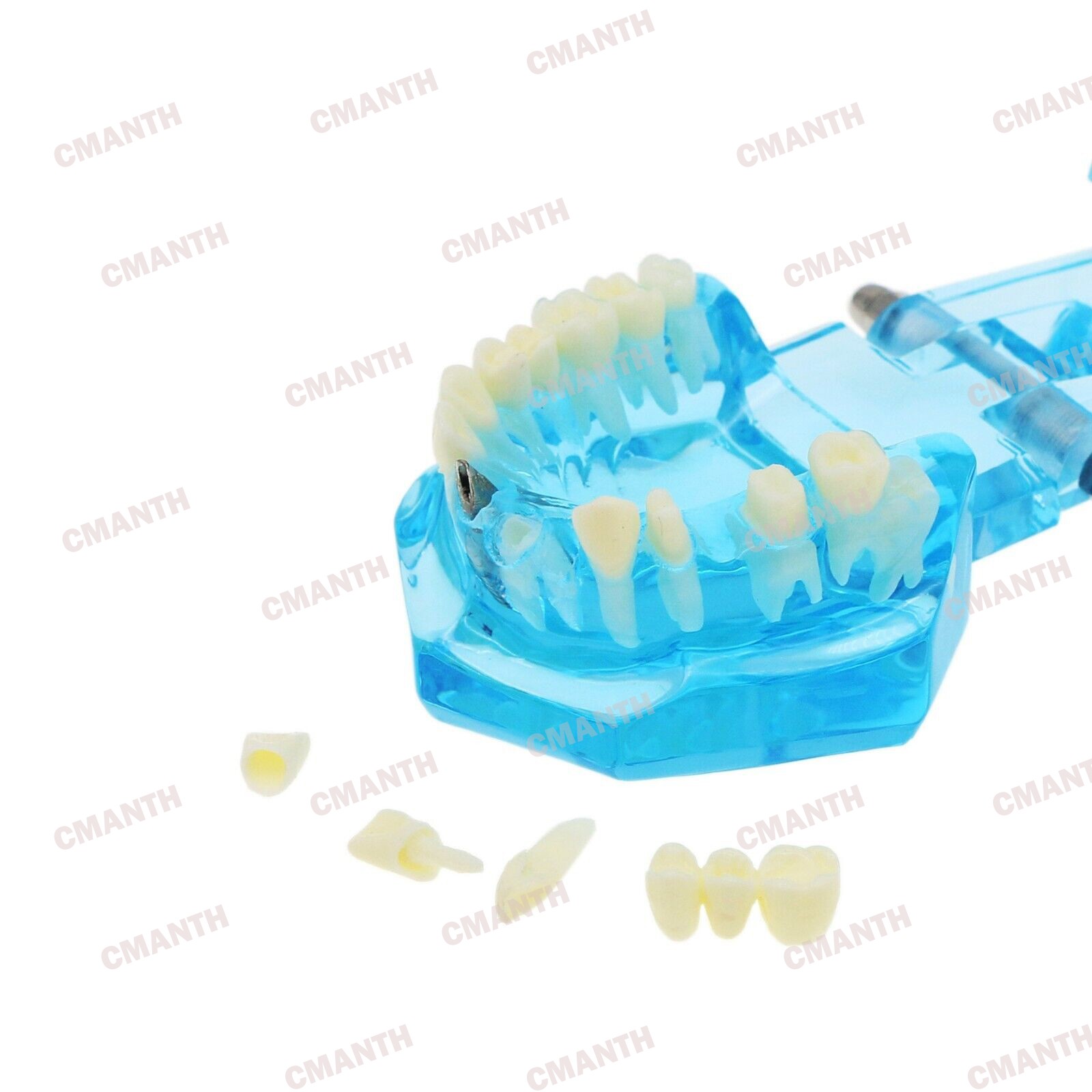 Dental Teeth Model Ortho Implant Practice Teaching of Implants Demo Model