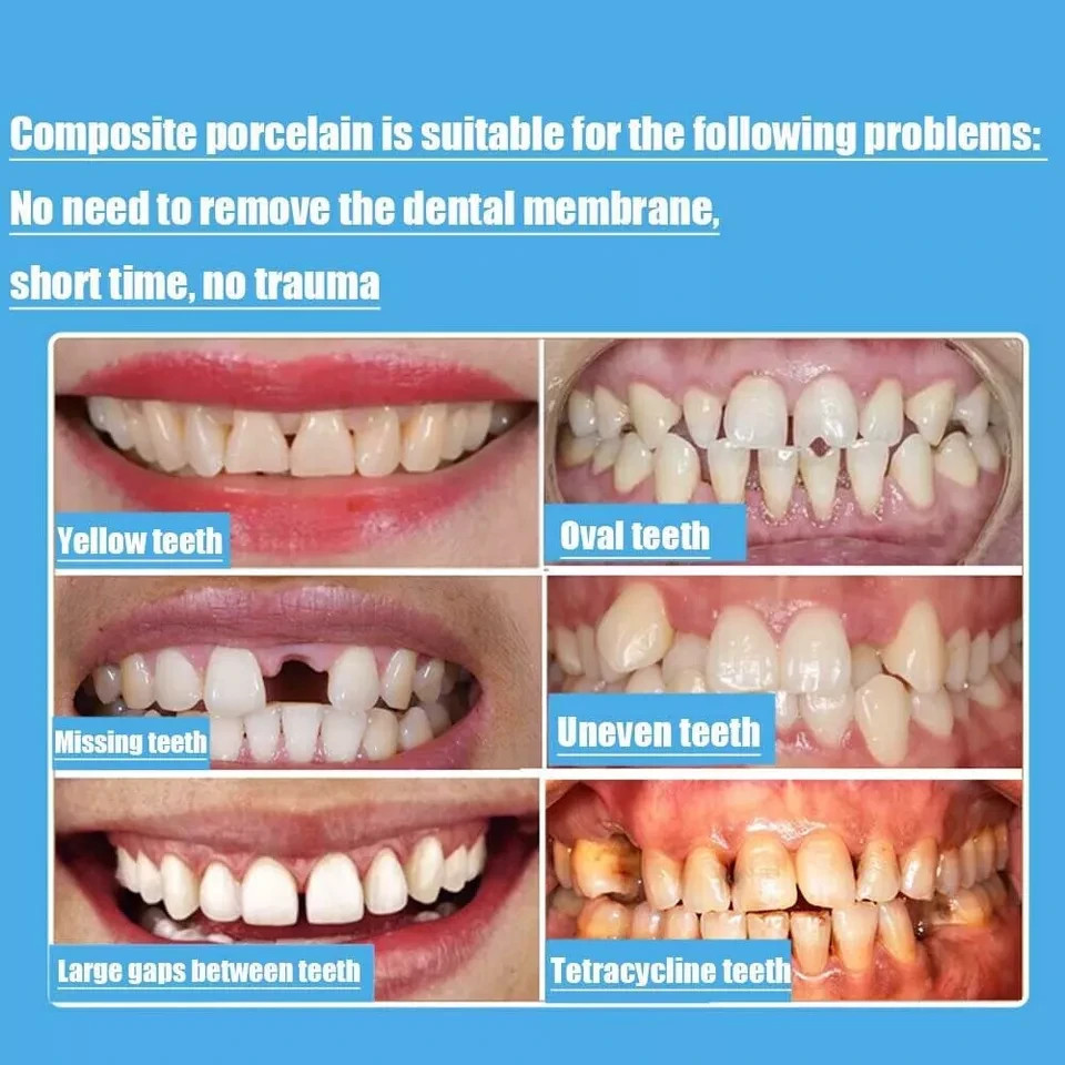 Dental Upper/Lower Composite Porcelain Veneer Whitening Front Teeth Bright White