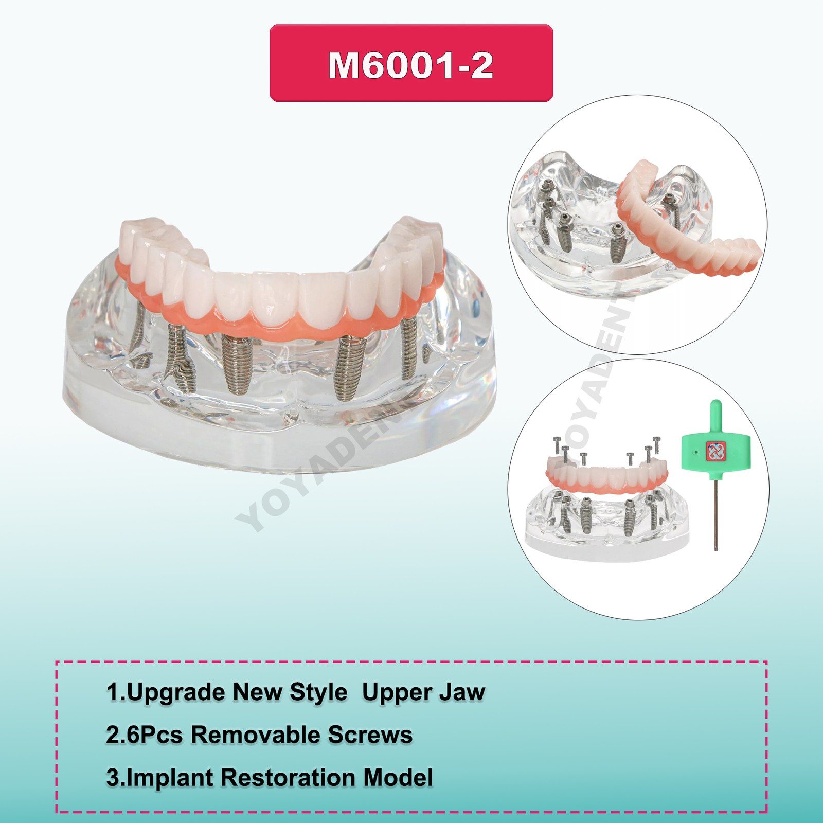 US Dental Implants Teeth Model Upper Lower Jaw 4/6 Overdenture Practice Demo