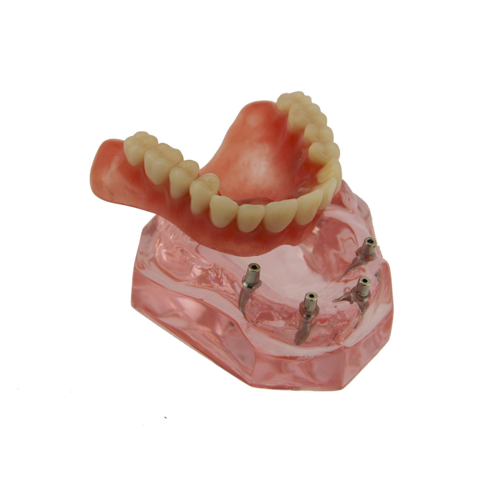 Dental Implants Restoration Model Overdenture Inferior With Demo Teaching Study