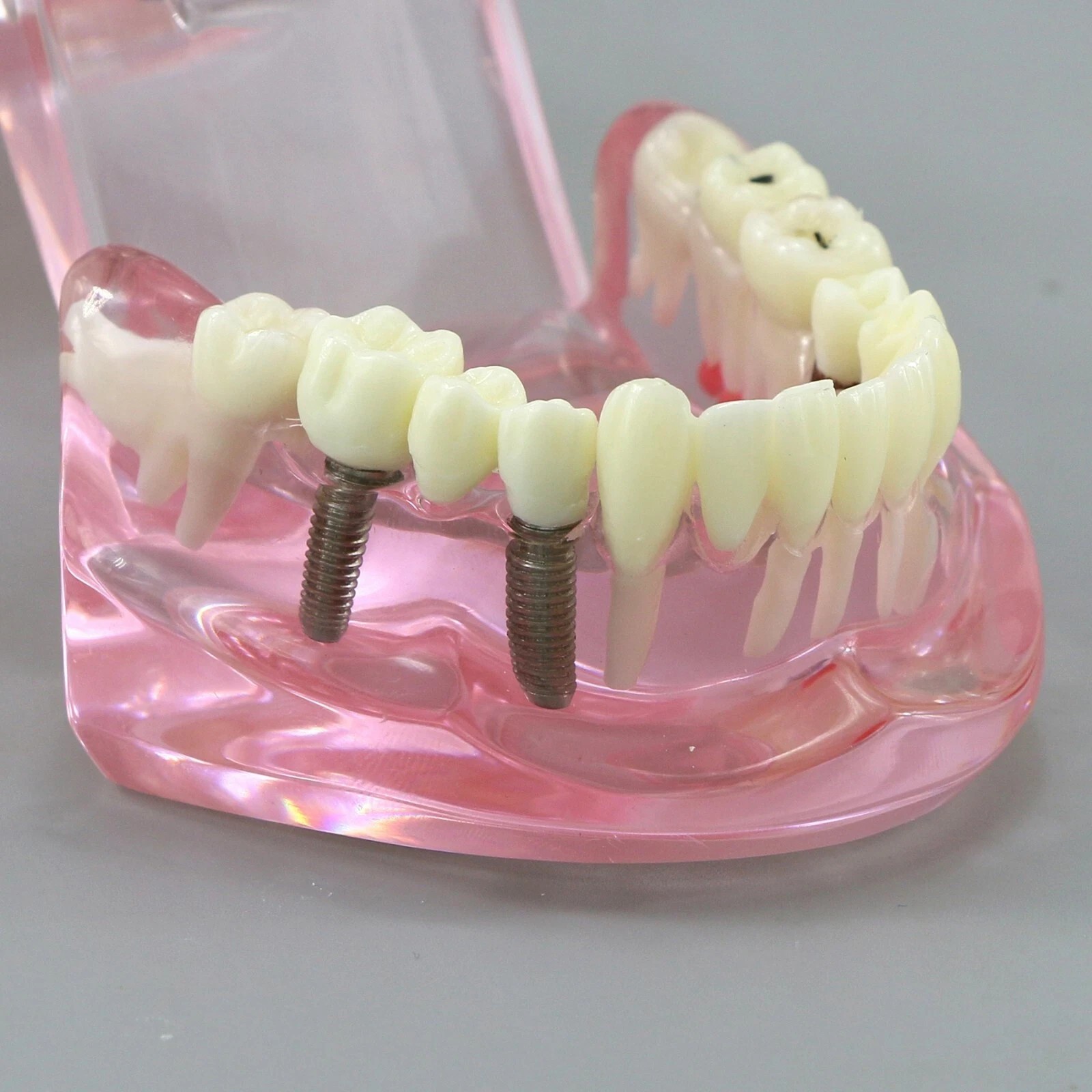 Dental Implant Teeth Model Teach Study Demo Restoration Pathology #2001 Pink