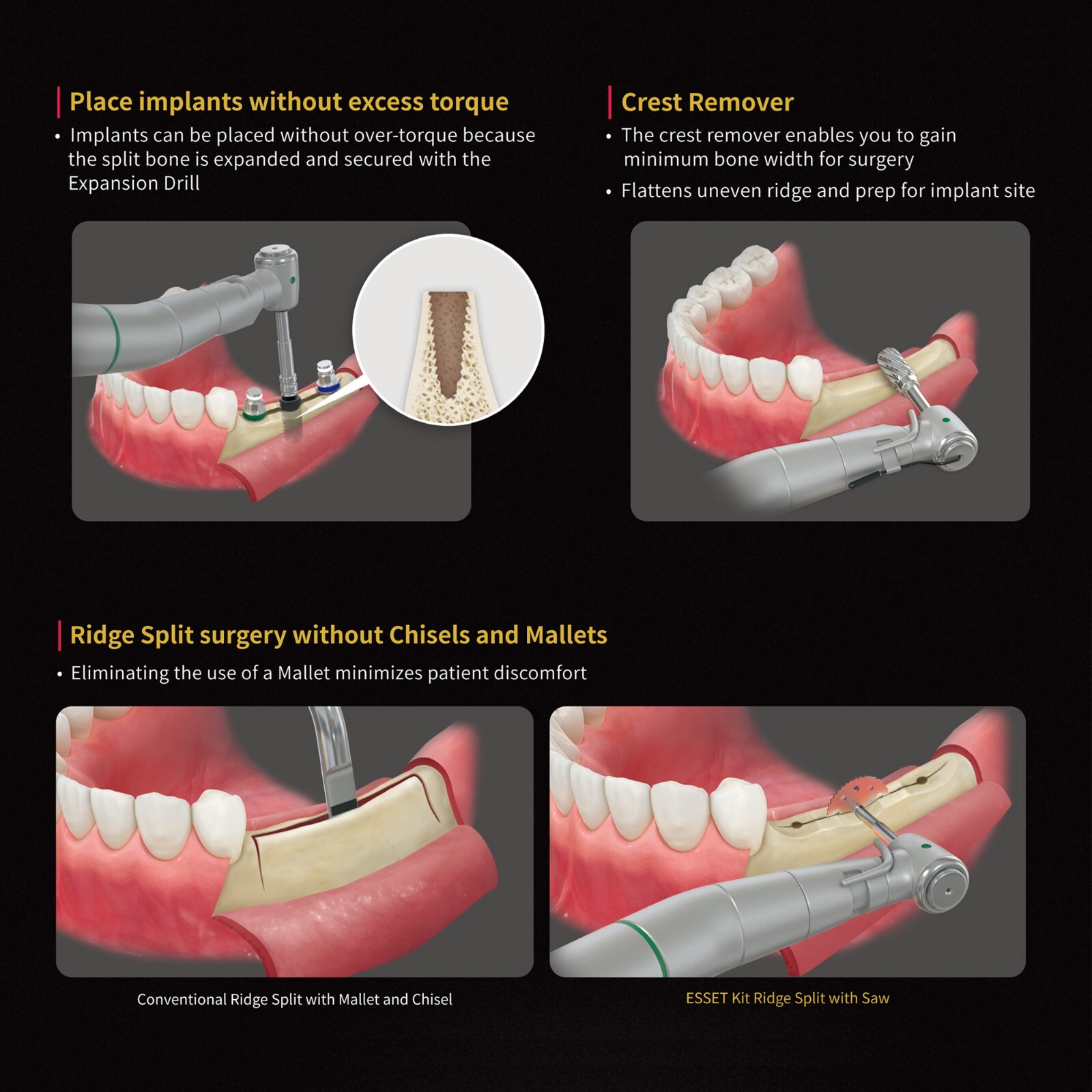 Implant ESSET Kit Easy Split Expansion of the Narrow Ridge HIOSSEN OSSTEM Style