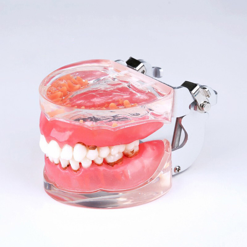 Dental Adult Pathological Periodontal Disease 4017# Dental Typodont Teeth Model