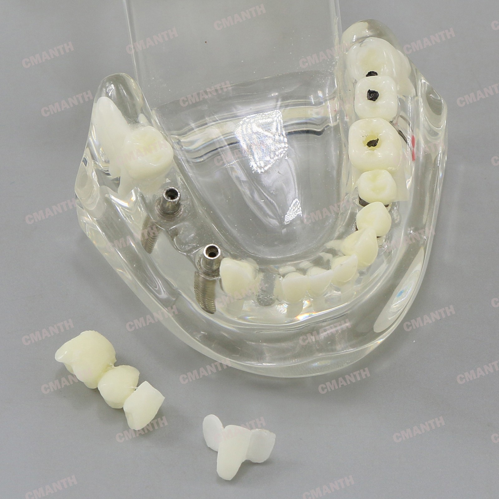 Dental Teeth Model Ortho Implant Practice Teaching of Implants Demo Model