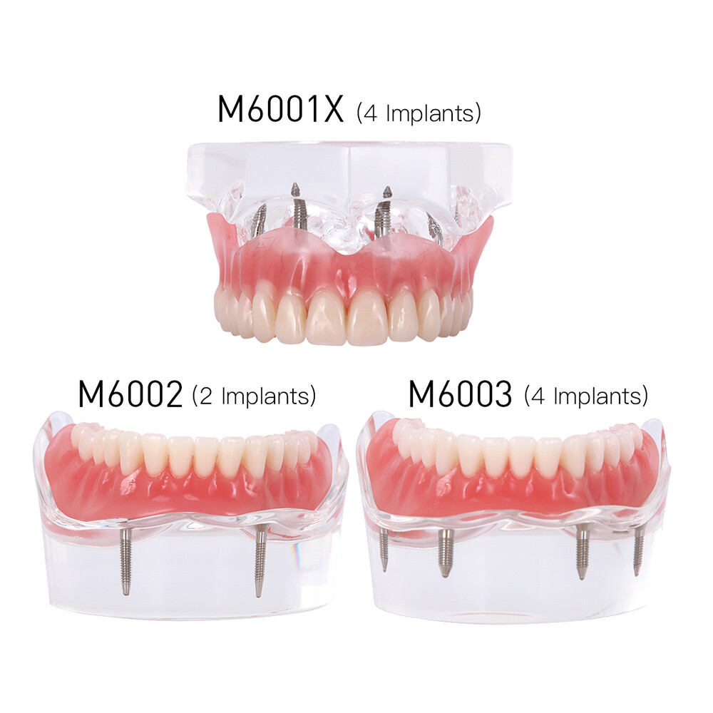 Dental Implant Teeth Model Demo Overdenture Restoration With 2 / 4 Implants