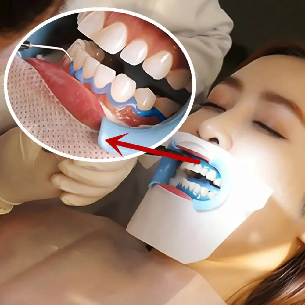Dental GINGIVA SHIELD VLC Light Curing Gingival Resin barrier, Blue 4 x 2g Pack