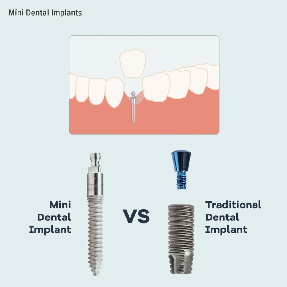 Dental Implant Replacement O-Ring Kit 3 Sizes Buna-N