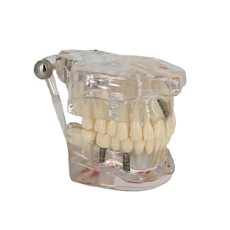 Dental Disease Teeth Model Tooth Demonstration Model for Dental Research Study