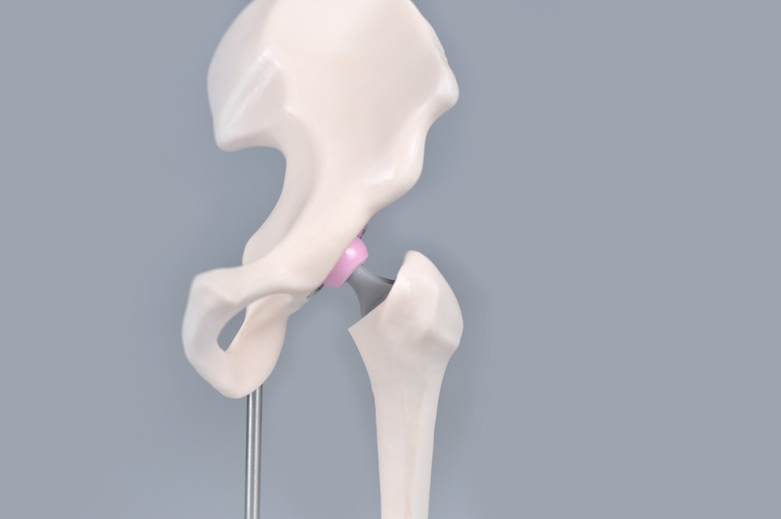 1/3 Artificial Hip Joint Replacement Anatomical Skeleton Demo Display Model