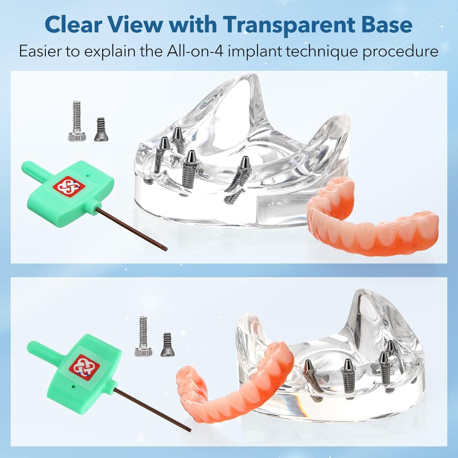 US Dental Overdenture Implant Model All-on-4 With 4 Screw Upper/Lower Clear Jaw