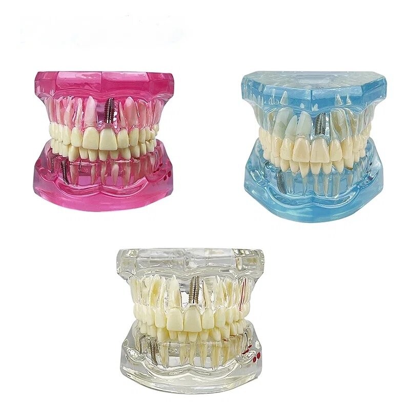 Dental Teeth Model Ortho Implant Practice Teaching With Implants Demo Model
