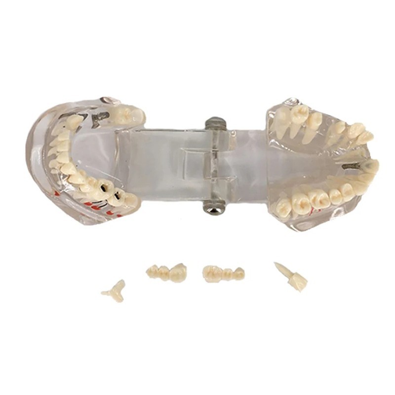 Dental Disease Teeth Model Tooth Demonstration Model for Dental Research Study