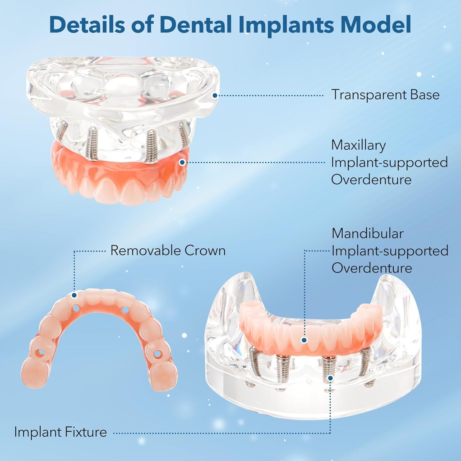 Dental Implant Model Overdenture Upper/Lower Jaw 4 Implant Clear Detachable US