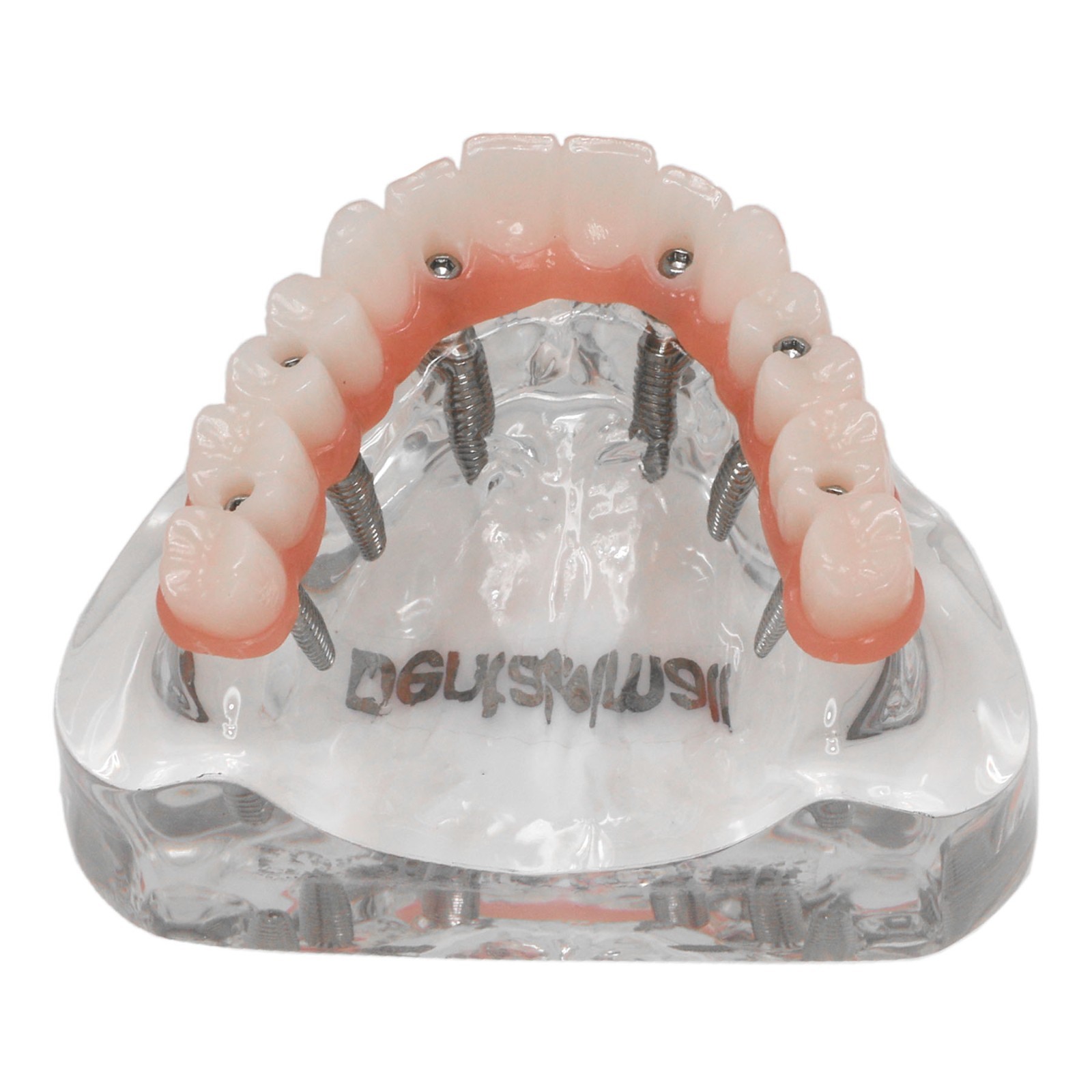 US Dental Implant Teeth Model Overdenture All on 4/All on 6 treatment Demo Model