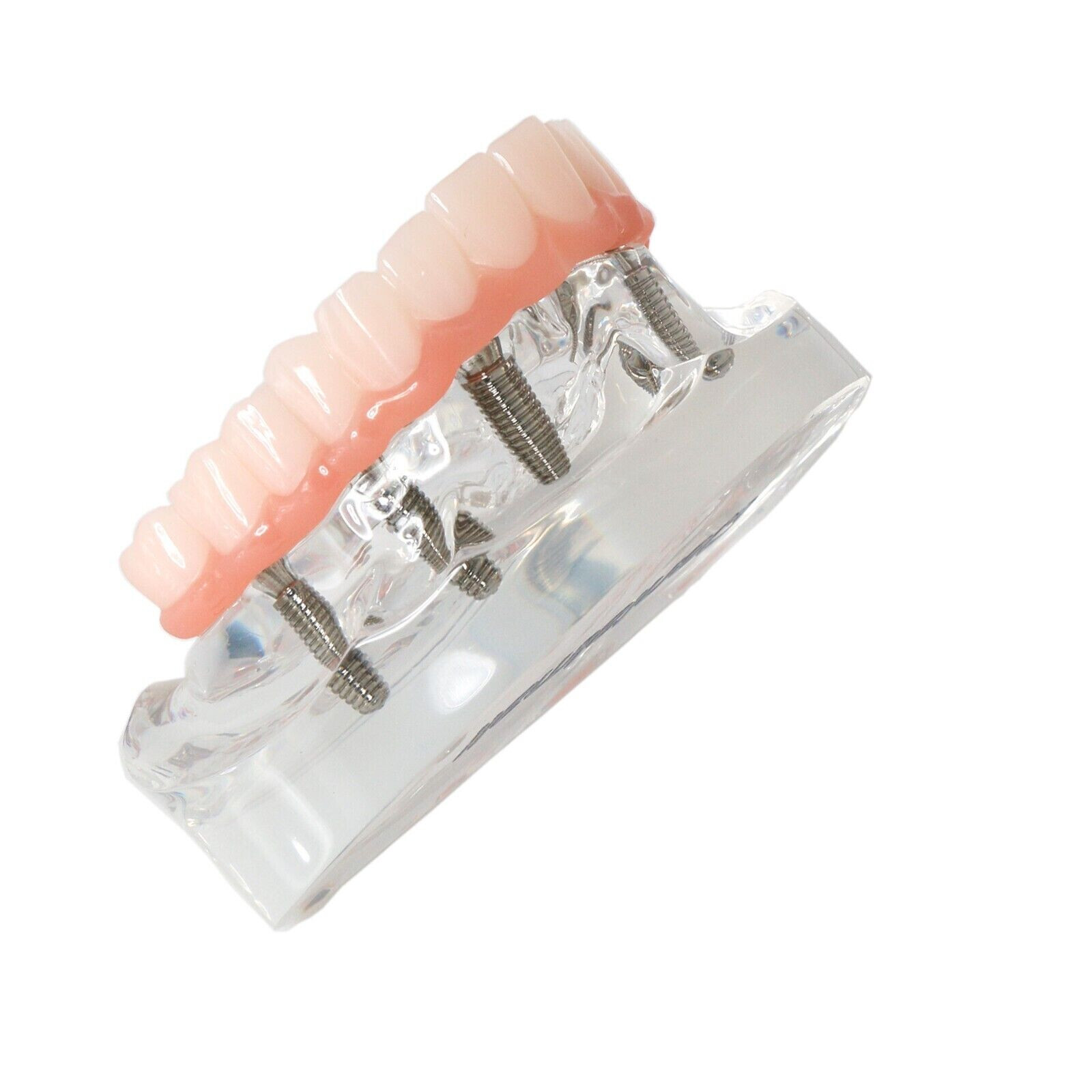 US Dental Implant Restoration Model Upper Jaw 6 Screws Post Core Bridge M6001-2