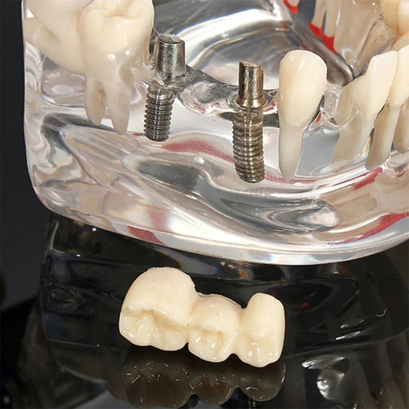 Dental Disease Teeth Model Tooth Demonstration Model for Dental Research Study