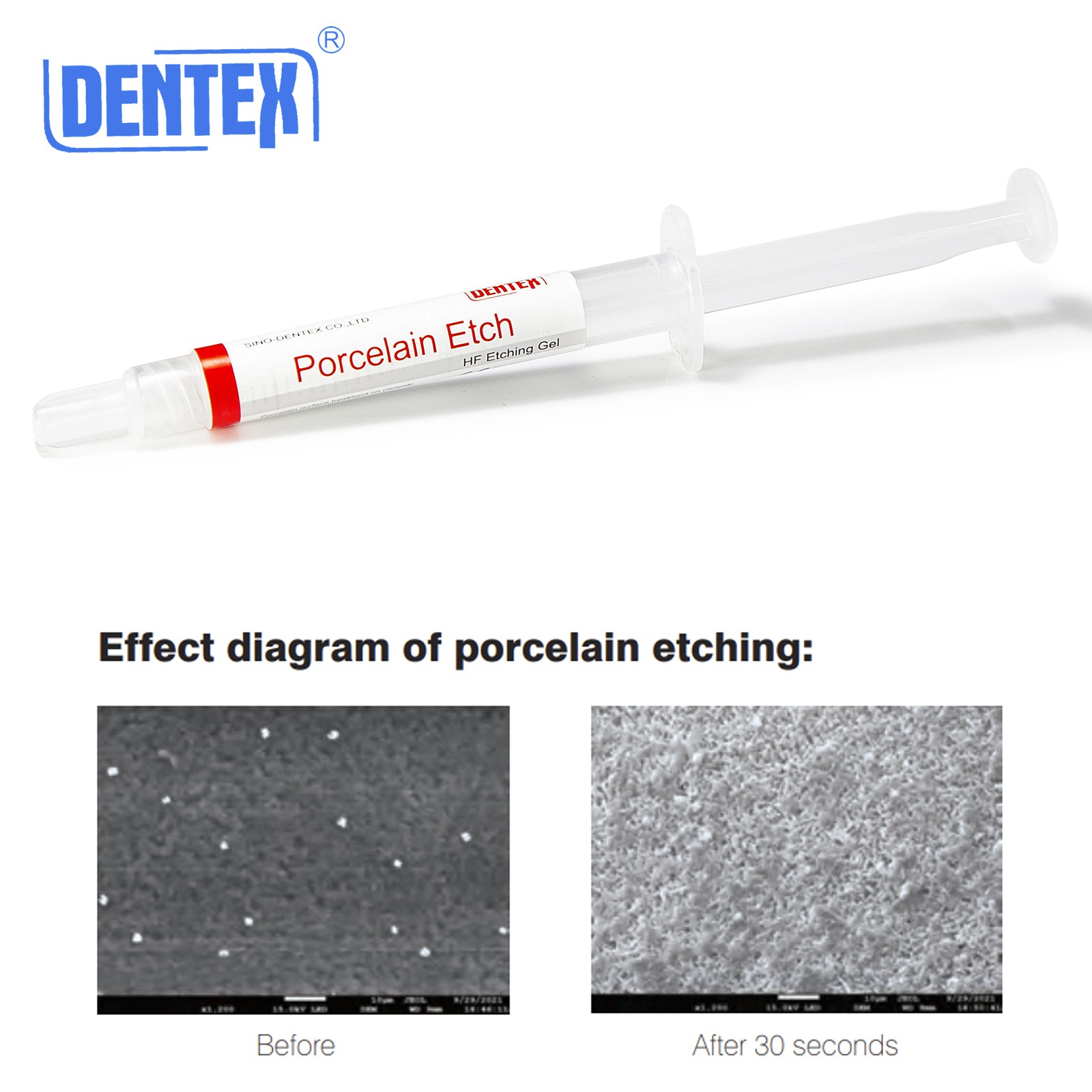 Dentex Dental Porcelain Etch Gel 9.5% Hydrofluoric Etchant Syringe/2.5ml