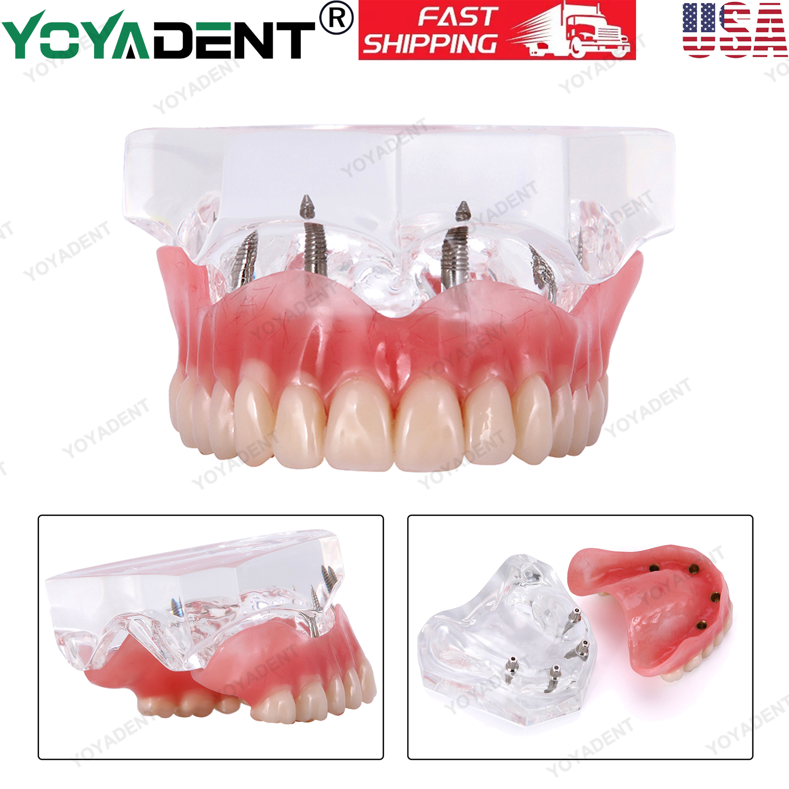 US Dental Implants Teeth Model Upper Lower Jaw 4/6 Overdenture Practice Demo
