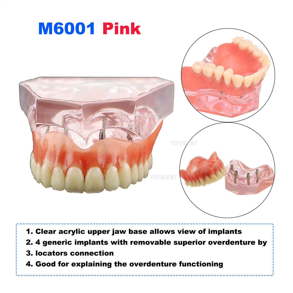 Dental Model 4 Implants superior/Mandibular Removable Overdenture Teeth Model