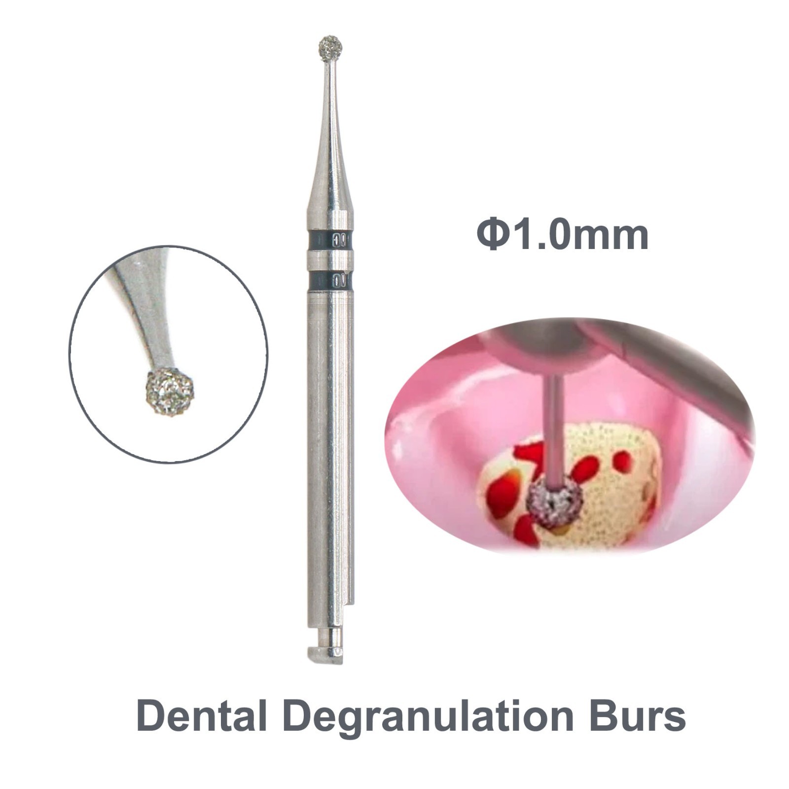 Dental Degranulation Burs Soft Tissue Removal Implant Surgery 1.0–3.5mm 4pcs Kit