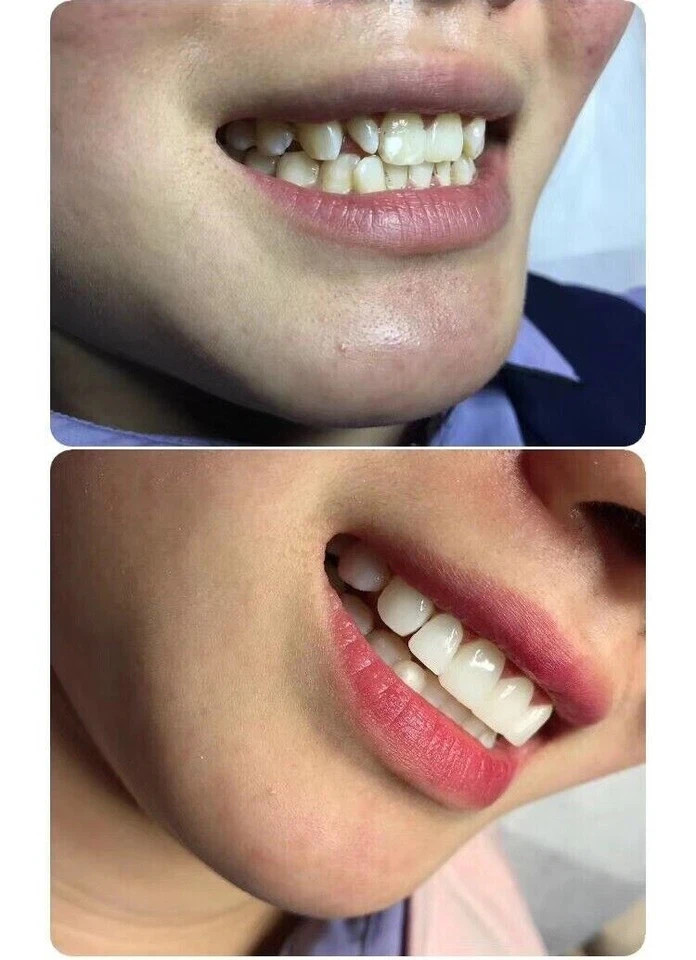 Dental Upper/Lower Composite Porcelain Veneer Whitening Front Teeth Bright White