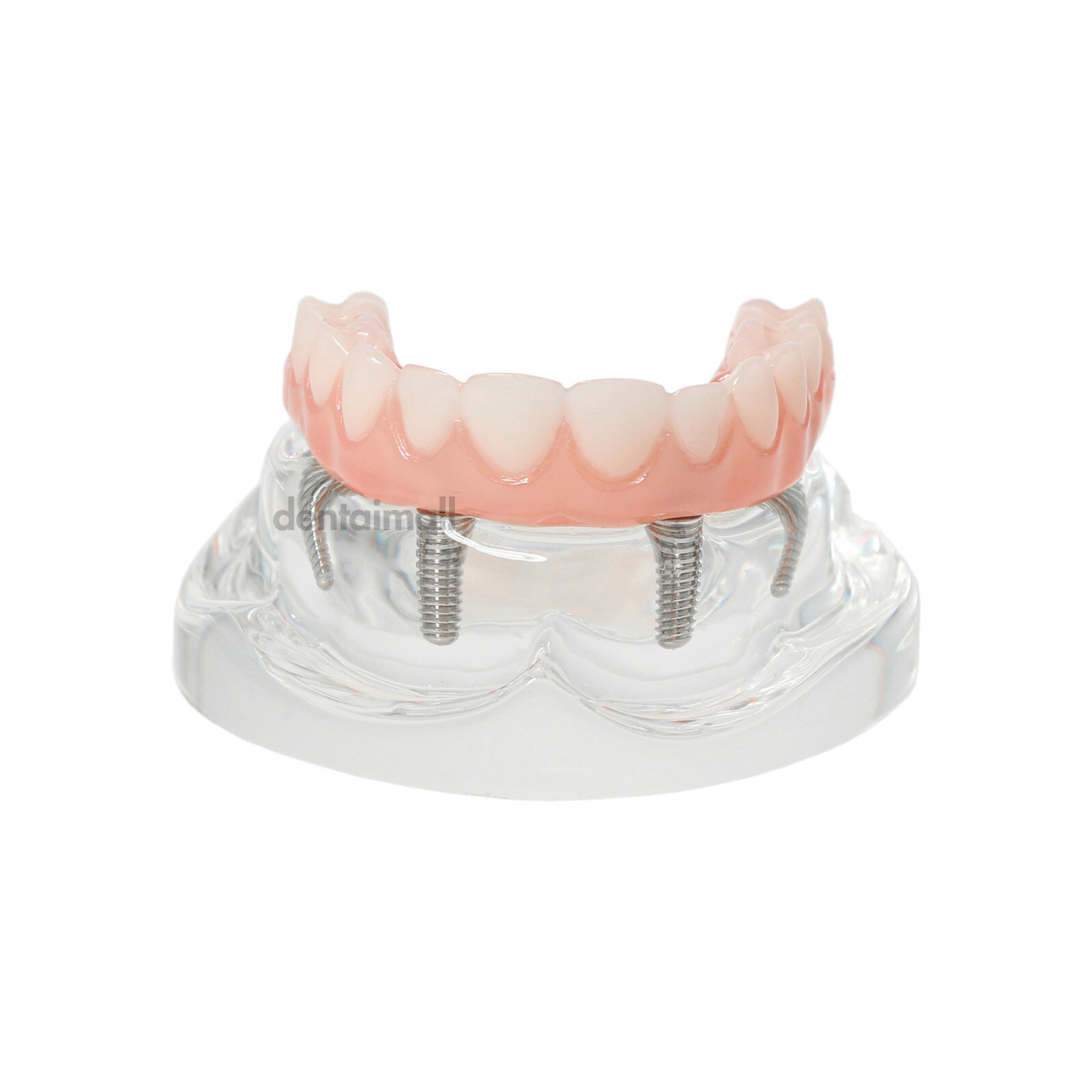 US Dental 4 Screws Overdenture Model All on 4 Restoration Upper/Lower Jaw Type