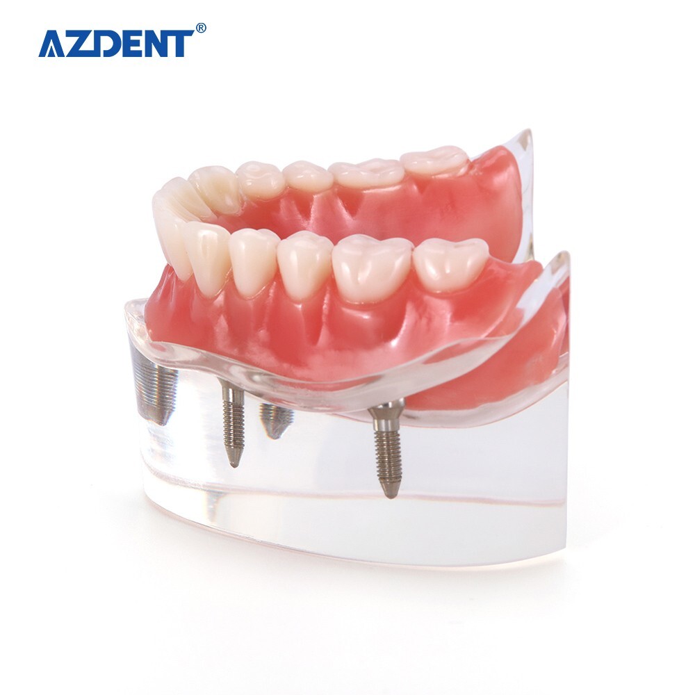 Dental Demonstration 4 Implants Teeth Model Typodont Inferior Overdenture Lower