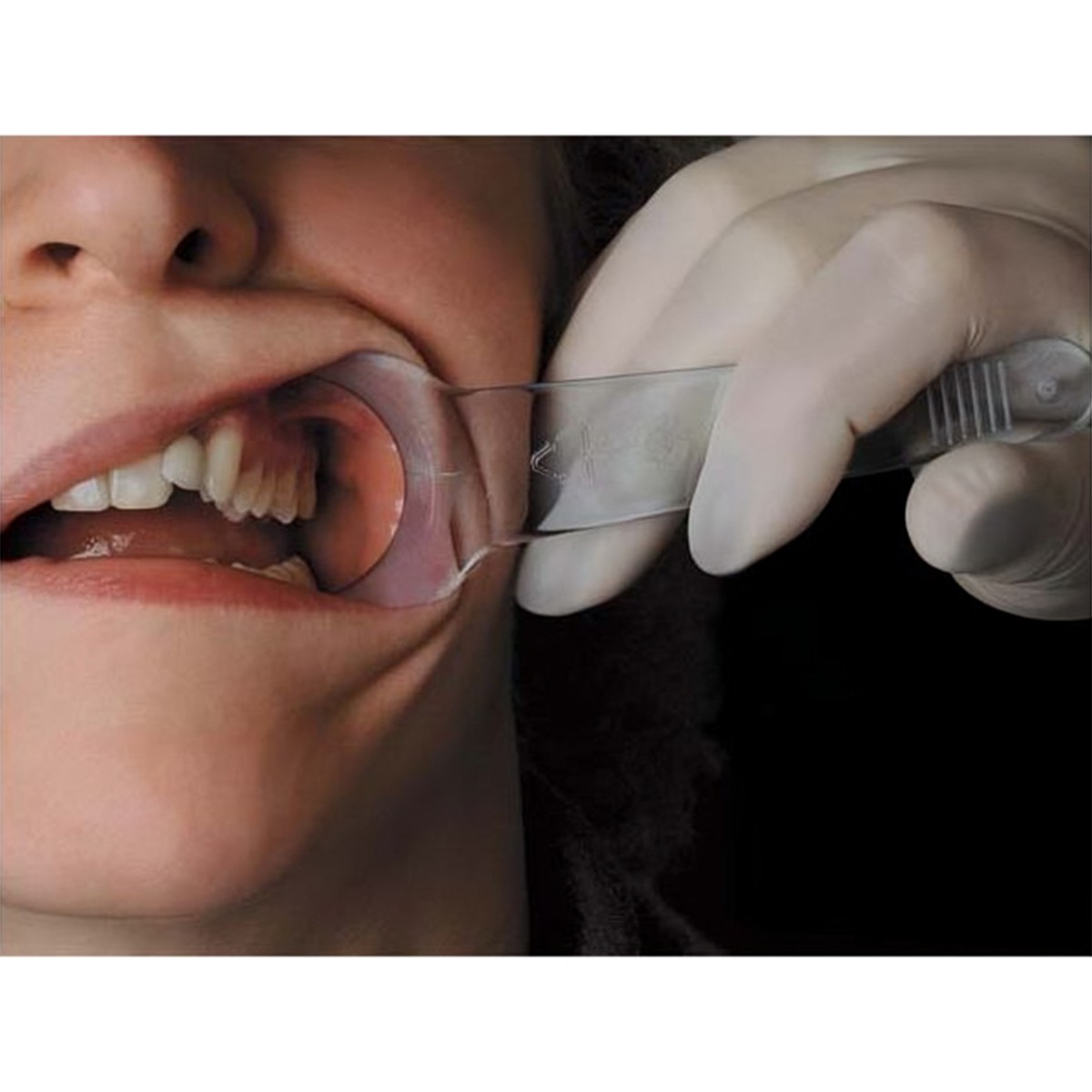 Cotisen Cheek Retractor Y Type- Small (Pack Of 2)