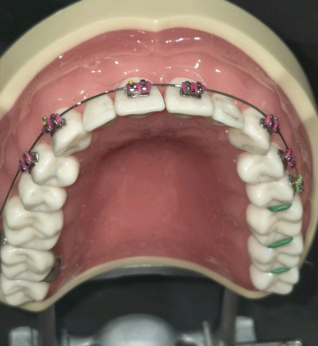 NISSIN PRO2001-UL-SP-DPM-32 Dental Typodont Model Teeth, With Braces See Photos