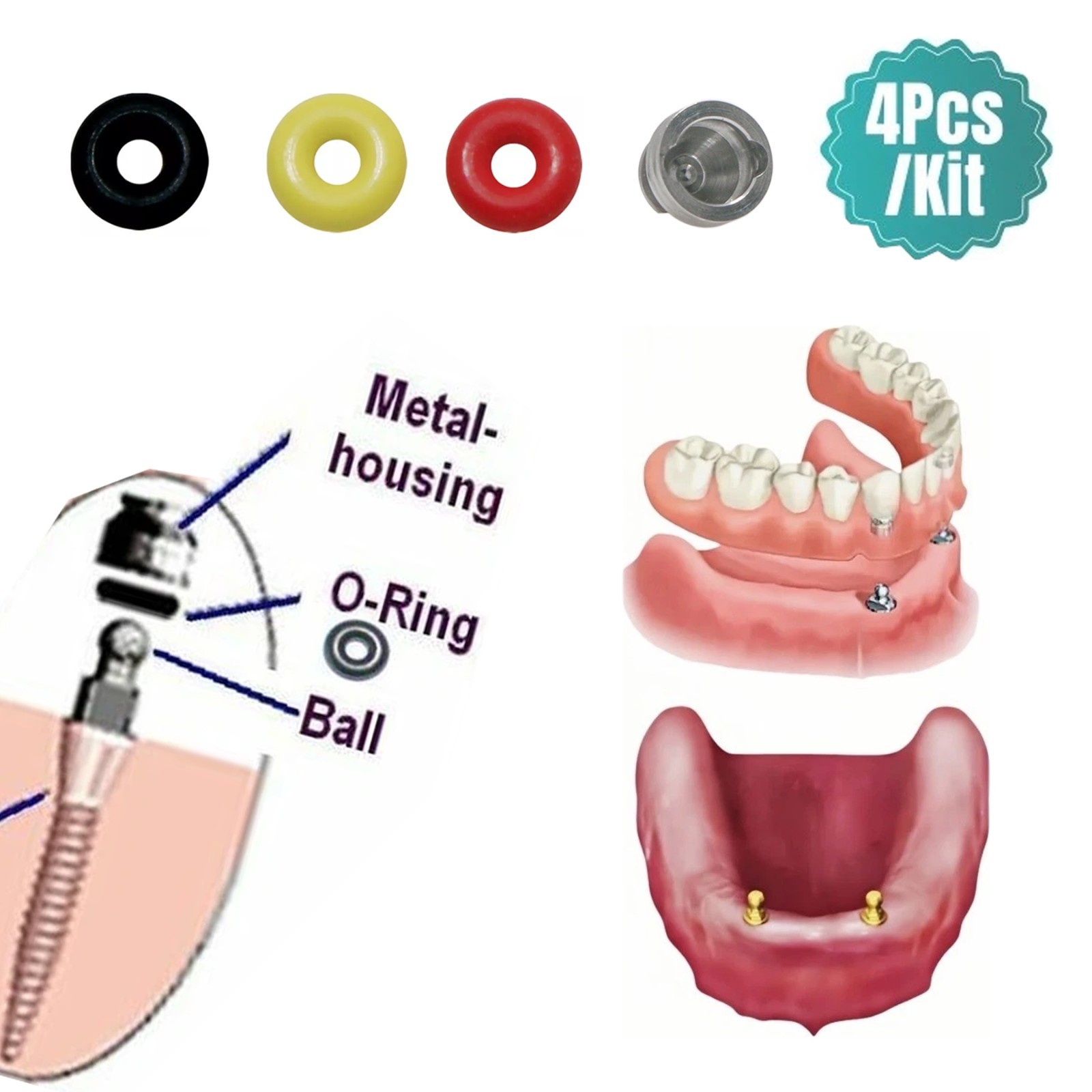 Dental Fit Hiossen/Osstem Implants Compatible Ball Abutment O-Ring Retention Cap