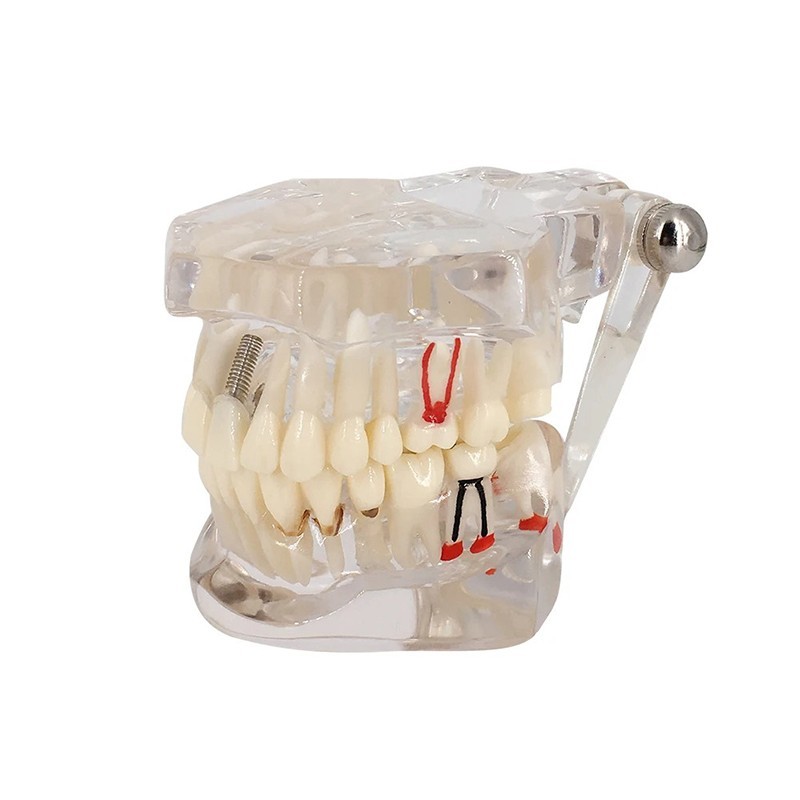 Dental Disease Teeth Model Tooth Demonstration Model for Dental Research Study
