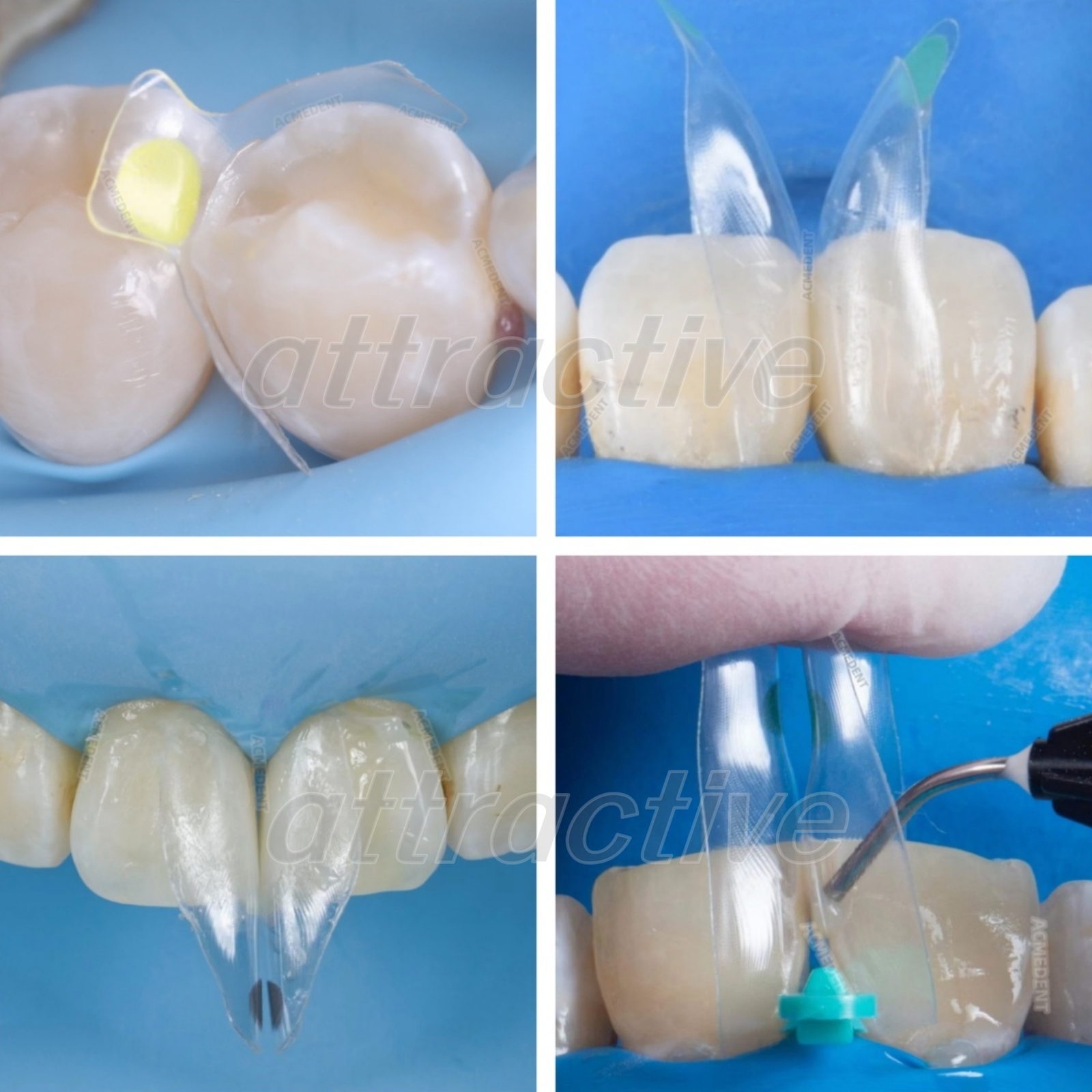 Dental Clear Matrix Anterior Posterior Restorative BT Bow Matrices Fit BioClear