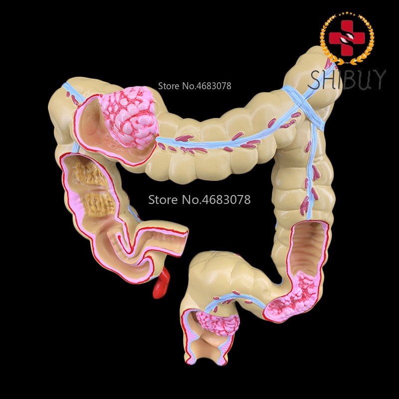 Colorectal Lesion Model Colon Large Intestine Pathological Model 14x17x21cm