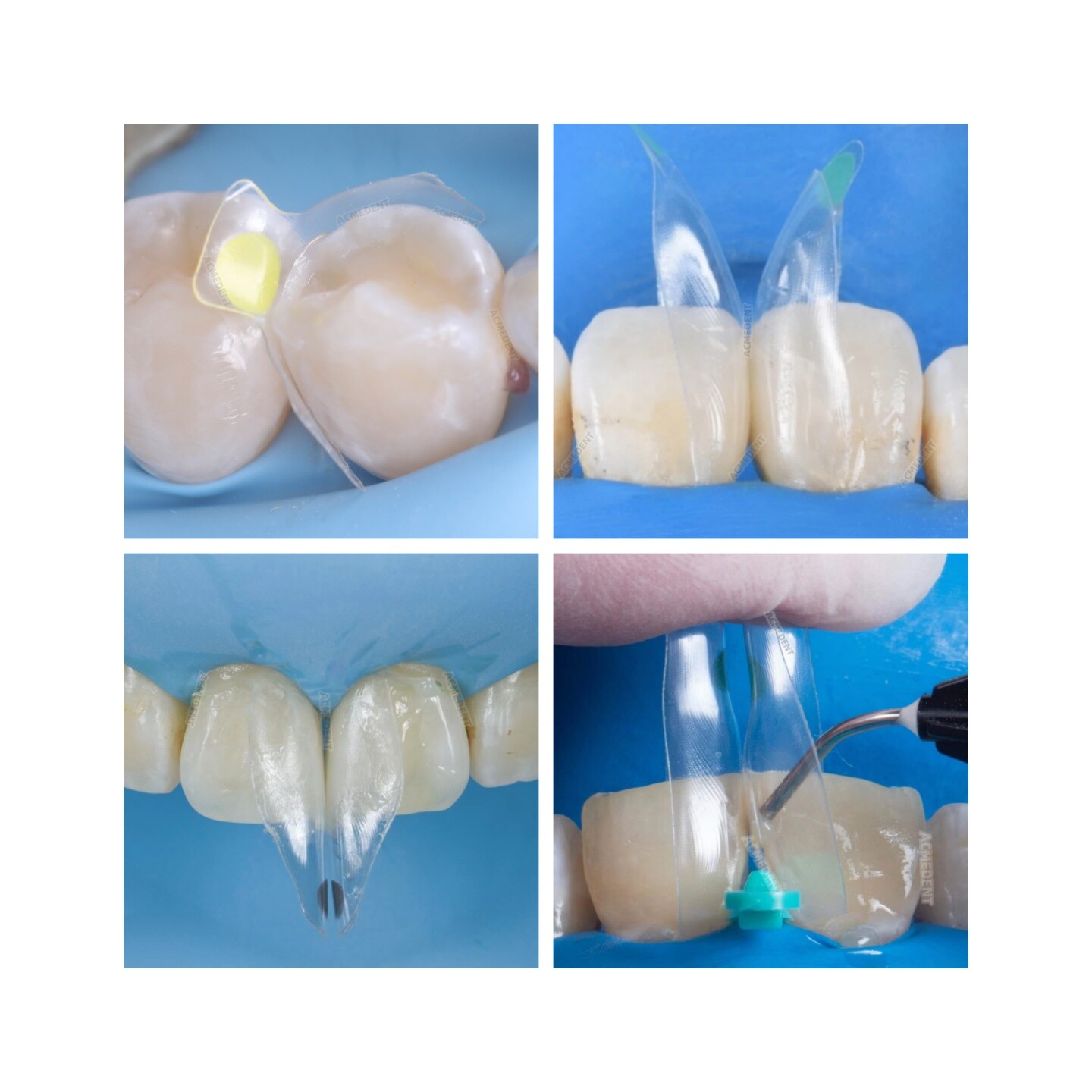 Clear Matrix Dental BT Matrices Black Triangle Wedges Diastema Fits BioClear