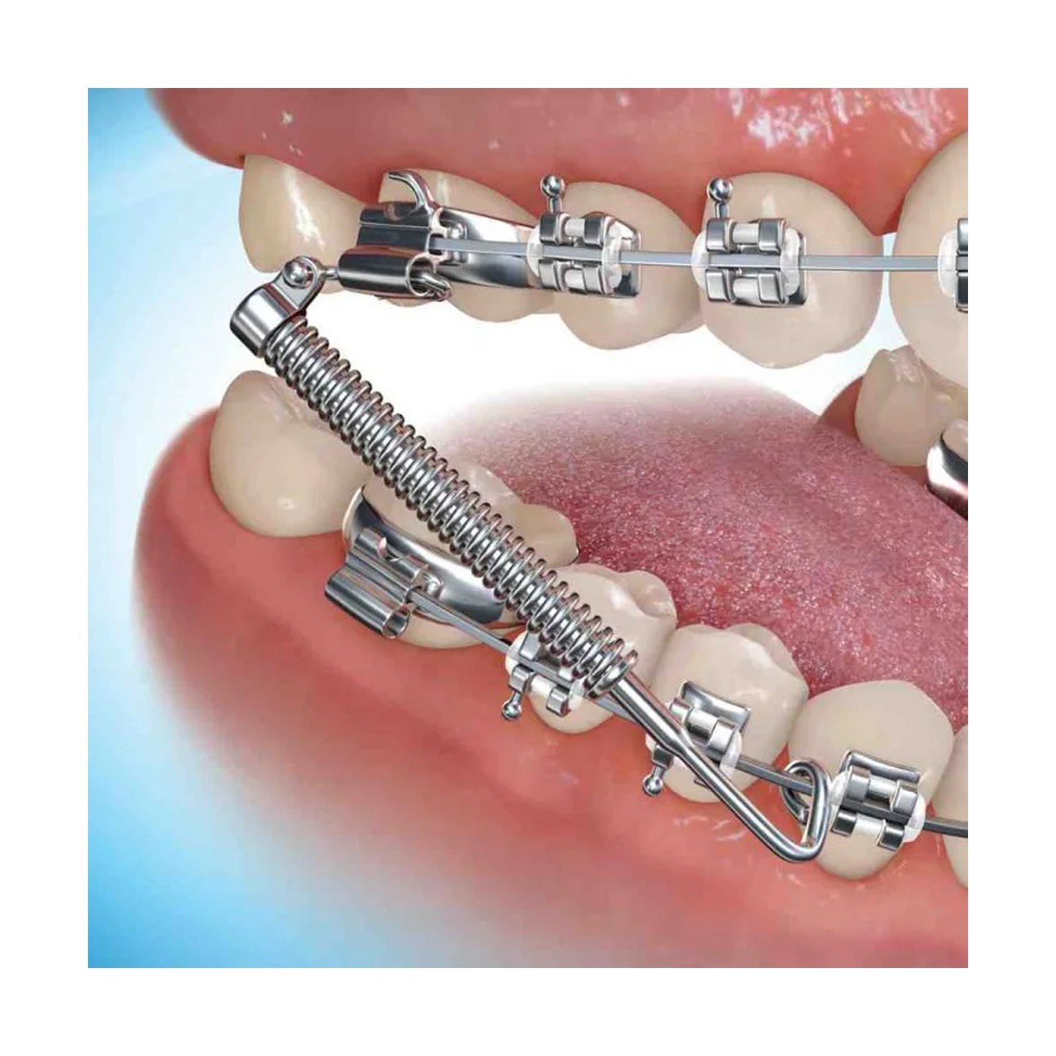 J&J BiteForce NC3 Orthodontic Device 3M Unitek Fatigue Resistant Compatible