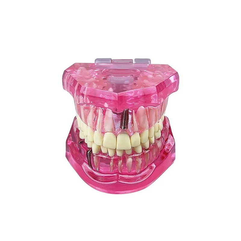 Dental Disease Teeth Model Tooth Demonstration Model for Dental Research Study