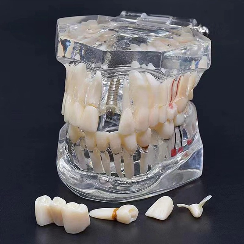 Dental Disease Teeth Model Tooth Demonstration Model for Dental Research Study