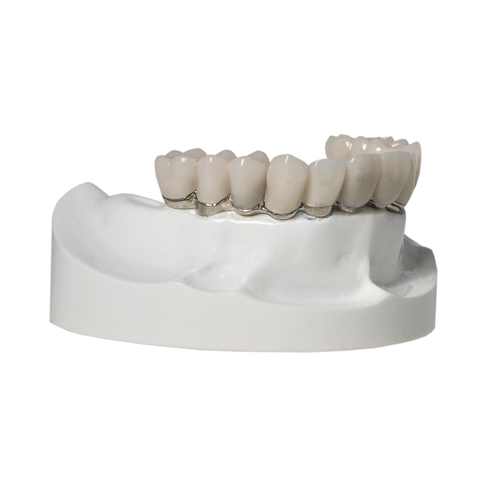 Implants Dental All-on-4 Overdenture Model Upper Jaw Restoration 4 Screws M6023
