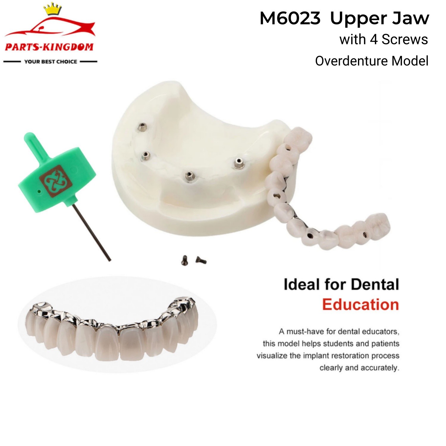 Upper Jaw Dental All-on-4 Overdenture Model Dental Implants Restoration 4 Screws