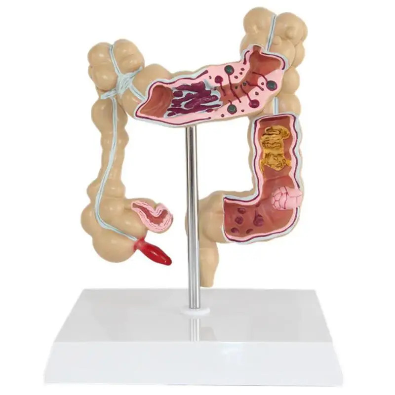 Colorectal Lesion Model Human Colon Large Intestine Pathological Diseases Model