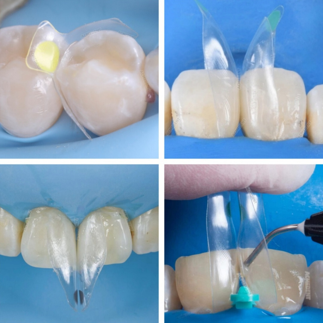 Dental Clear Matrix Transparent Restoration BT Bow Matrices Contoured BioClear