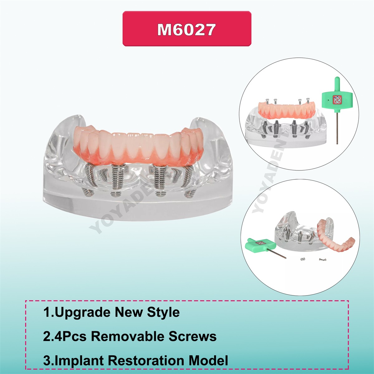 US Dental Implants Teeth Model Upper Lower Jaw 4/6 Overdenture Practice Demo
