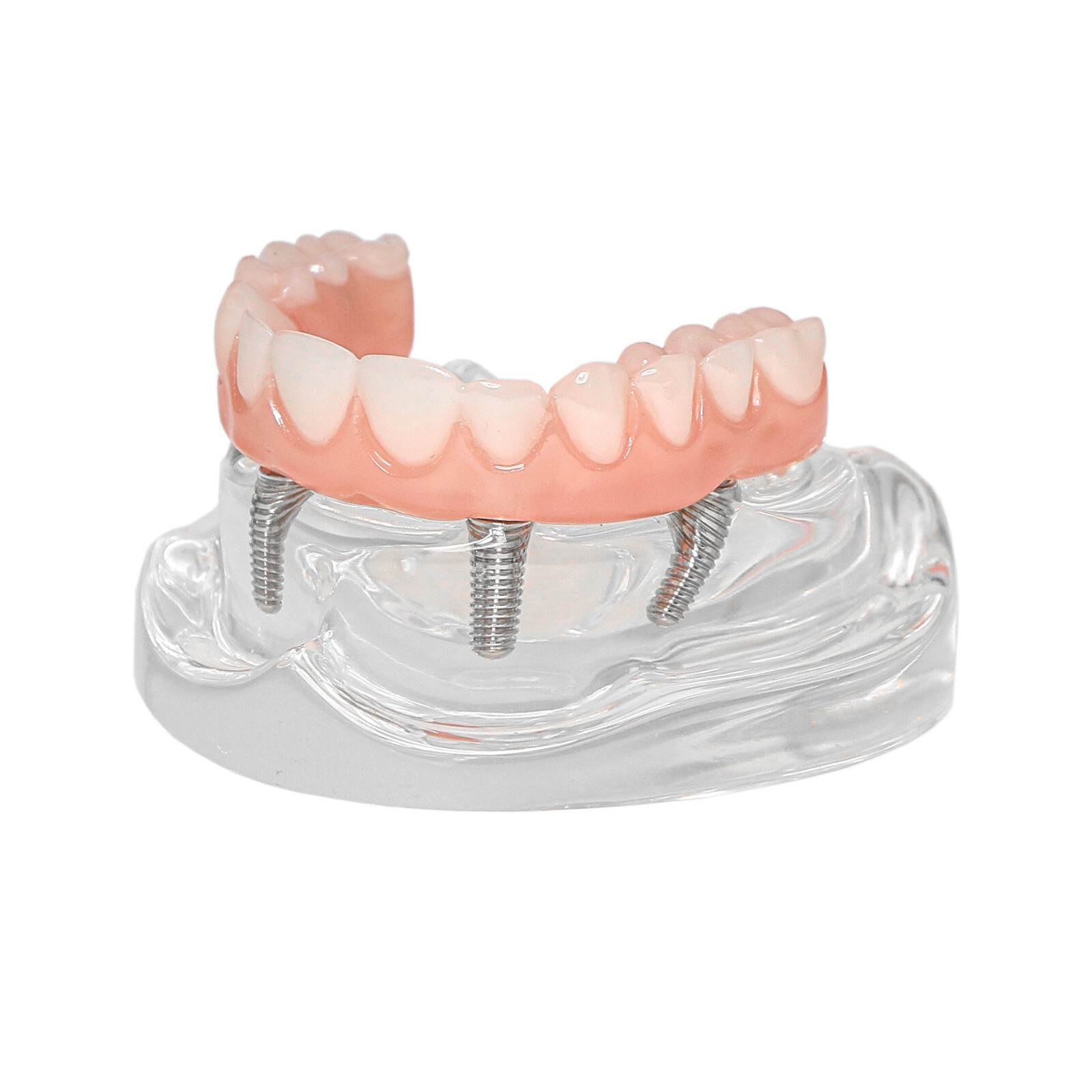 Dental 4 Implants Upper&Lower Demo Implant Teeth Model Restoration Overdenture