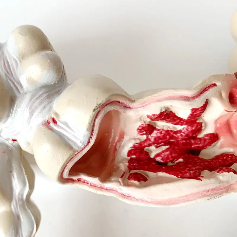 Colorectal Lesion Model Human Colon Large Intestine Pathological Diseases Model