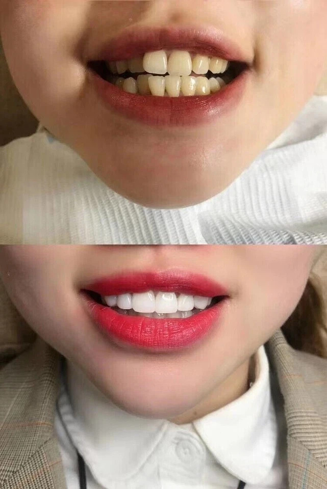 Dental Upper/Lower Composite Porcelain Veneer Whitening Front Teeth Bright White
