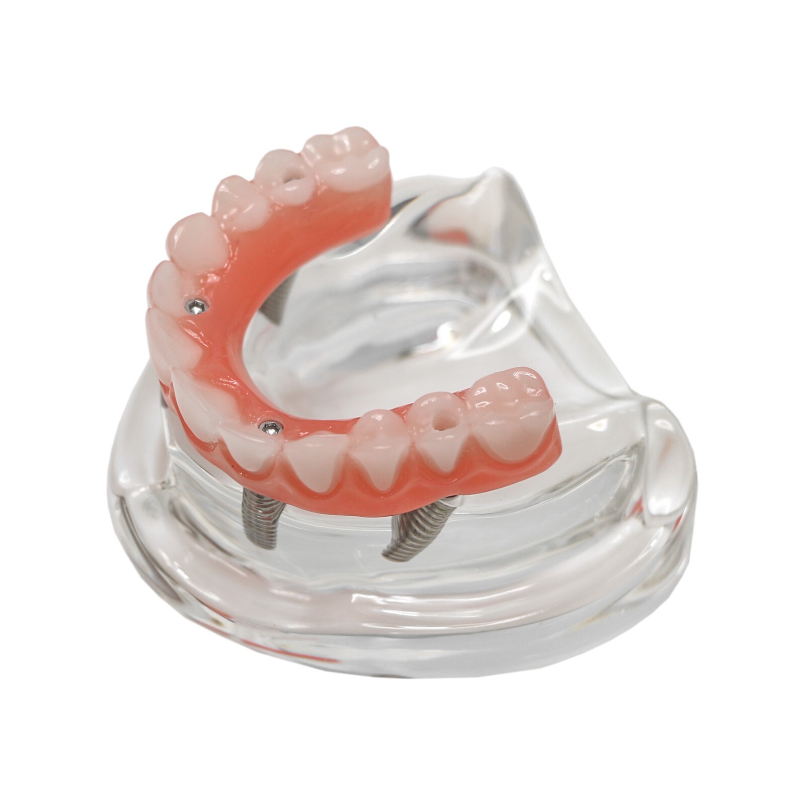 US All-on-4/All-on-6 Dental Implant overdenture Treatment Model with 4/6 Screws