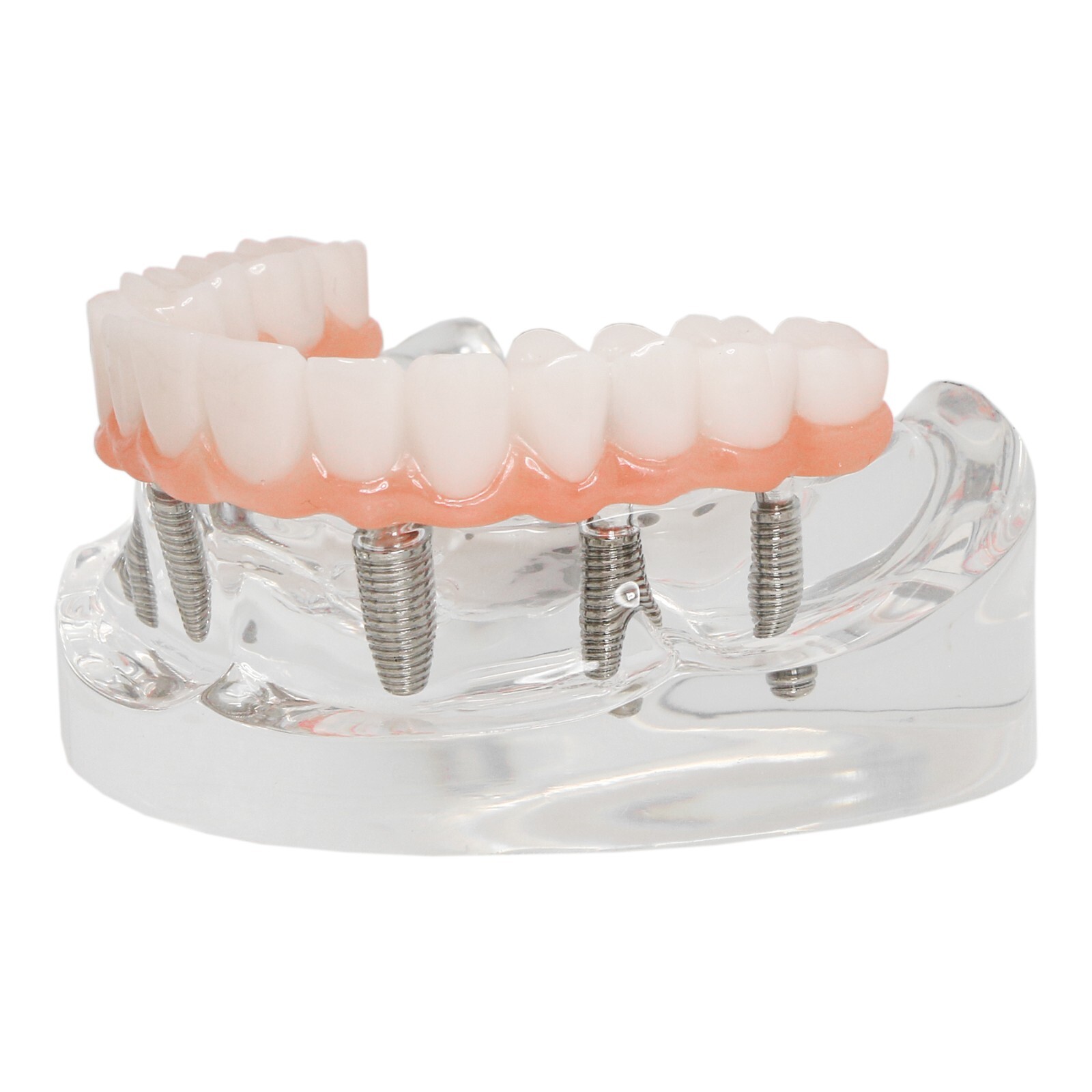 Dental Implant Overdenture Model All-On-6 Treatment Upper jaw 6 Screws, Clear US