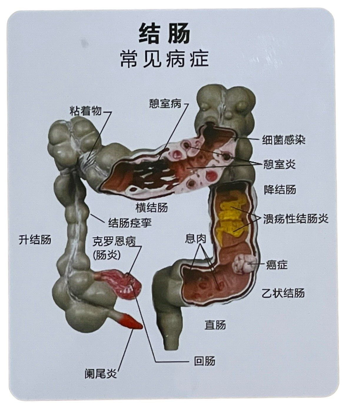 Colon Anatomy Model W Pathologies Medical Human Large Intestine 7.75″ x 6″